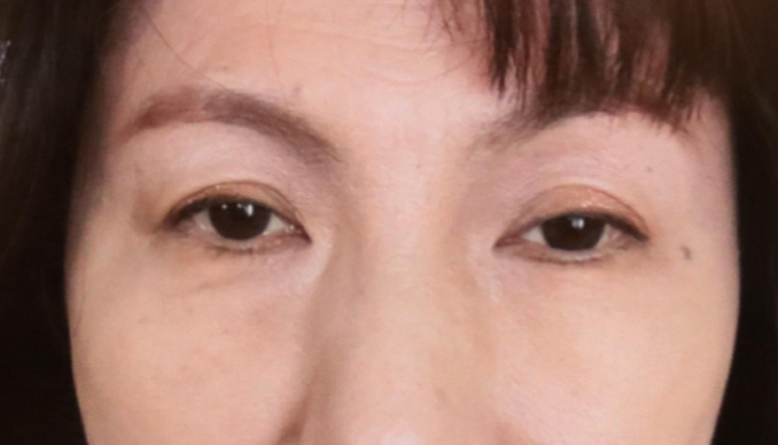 眼瞼下垂修正手術 術前