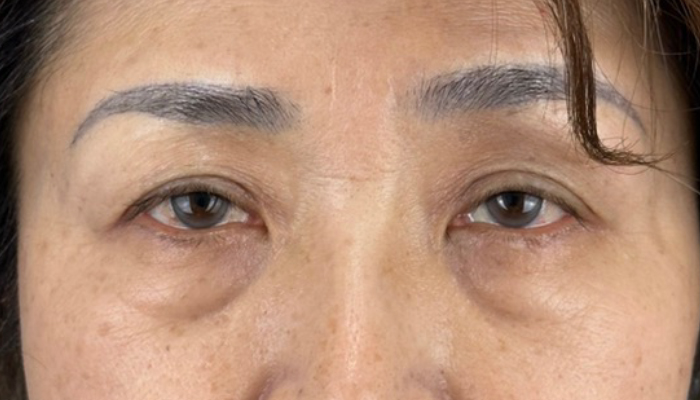 眼瞼下垂修正手術 術前