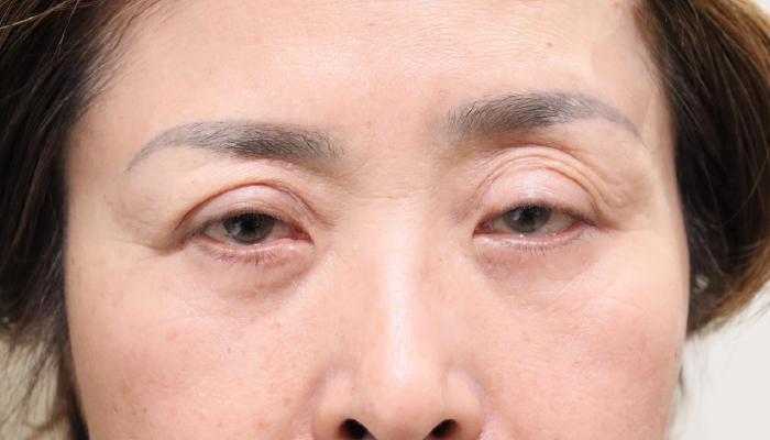 眼瞼下垂修正手術 術後