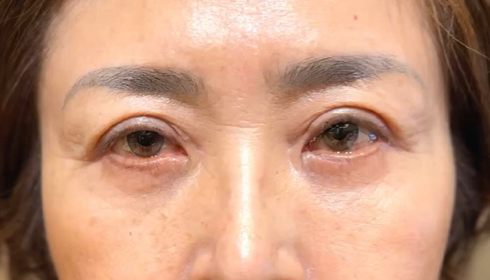 眼瞼下垂修正手術 術後