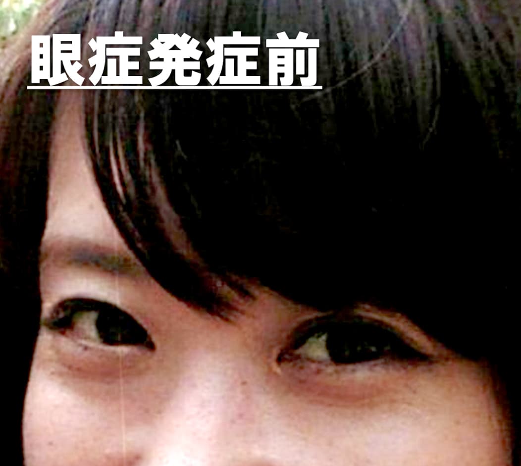 眼形成手術+脂肪移植 症例紹介