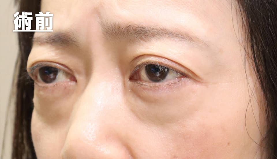 眼形成手術+脂肪移植 症例紹介