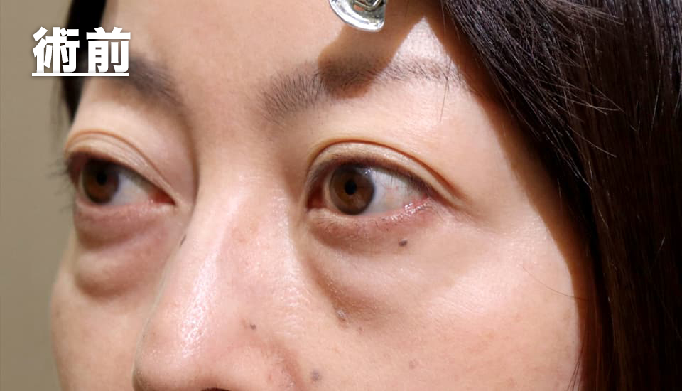 眼形成手術+脂肪移植 症例紹介